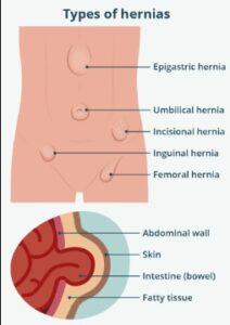 Mild abdominal hernia illustration showing early-stage tissue protrusion